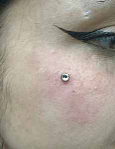 Colocación de piercing en zona de Zabalburu con técnica segura